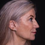 Before volumetric facelift with jowl lift and chin, jaw, and cheek filler, addressing sagging cheeks and sagging jawline.