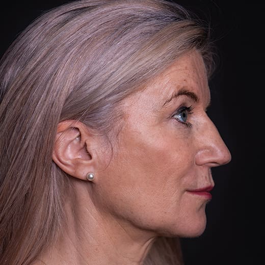 Before volumetric facelift with jowl lift and chin, jaw, and cheek filler, addressing sagging cheeks and sagging jawline.