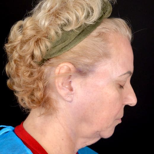 Before deep plane face and neck lift with jowl lift, addressing jowls, sagging neck, and sagging jawline