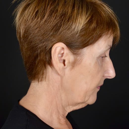 Before deep plane facelift and neck lift, addressing sagging neck and jawline.