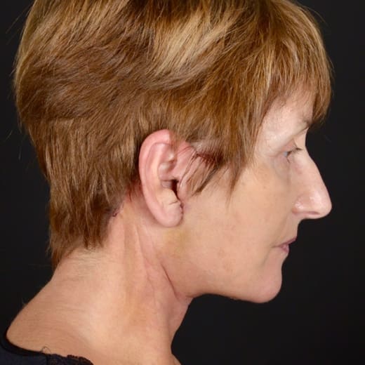 After a deep plane face and neck lift, and eyelid surgery
