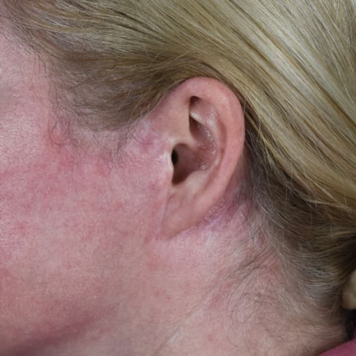 After laser treatment to address scarring