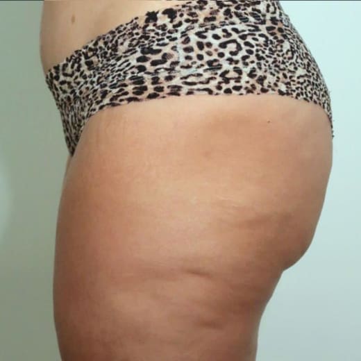 Inner Thighs Treatment