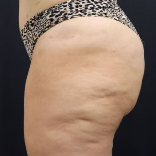 Inner Thighs Treatment