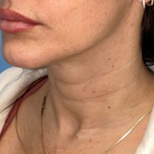 Sofwave® Skin Tightening Glasgow