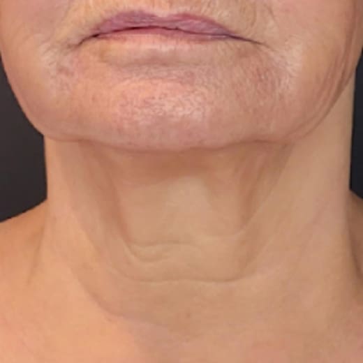 Sofwave® Skin Tightening Glasgow
