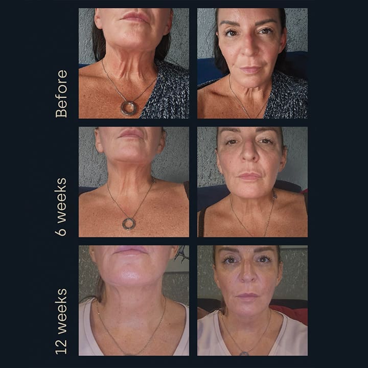 Sofwave® Skin Tightening Glasgow