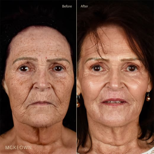 Laser skin resurfacing before and after